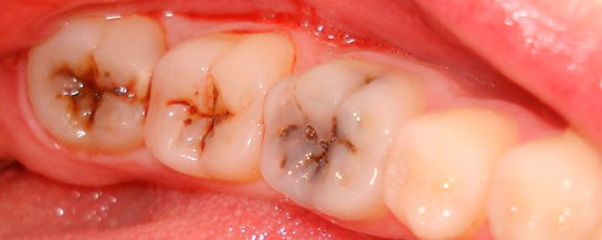 Rüyada Diş Çürüğü Görmek Rüya Yorumu ve Anlamı