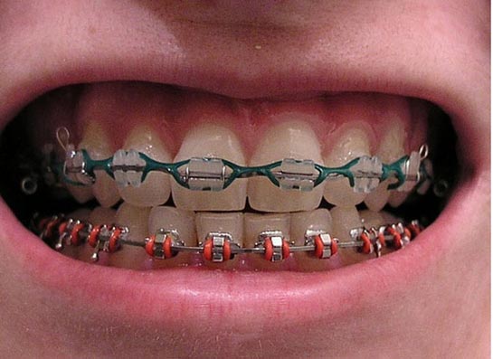 Rüyada Diş Teli Görmek Rüya Yorumu ve Anlamı