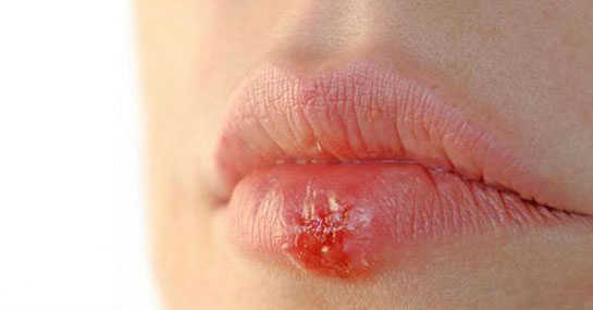 Rüyada Dudak Uçuklaması Rüya Yorumu ve Anlamı