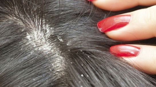 Rüyada Kepekli Saç Görmek