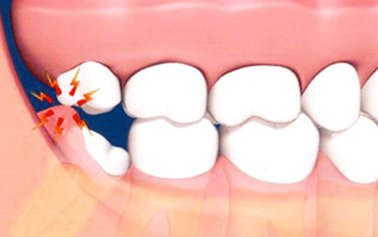 Rüyada Yirmilik Diş Çektirmek Rüya Yorumu ve Anlamı